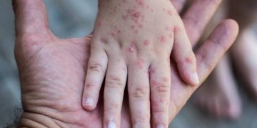 Confirma Secretaría de Salud dos casos de viruela símica en Sonora&nbsp;