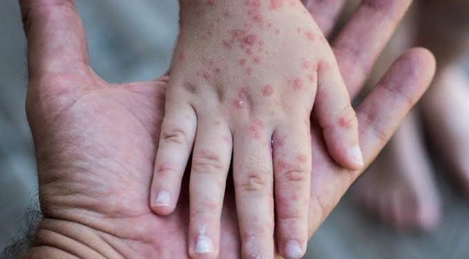 Confirma Secretaría de Salud dos casos de viruela símica en Sonora